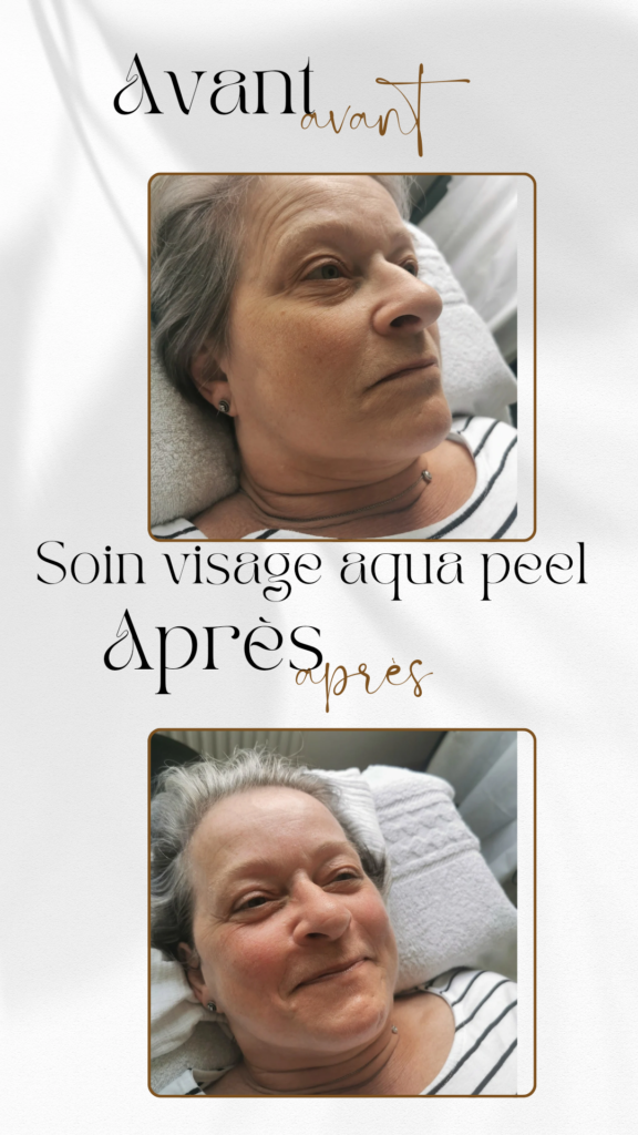 résultat du soin hydrafacial avant après