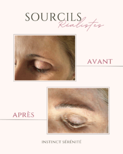 avant après dermo pigmentation
